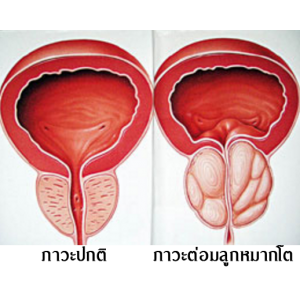 ต่อมลูกหมาก