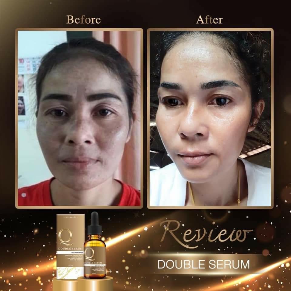 เซรั่มคิว ลดสิว ฝ้า กระ หน้าเด้ง 30ml. Q Double Serum