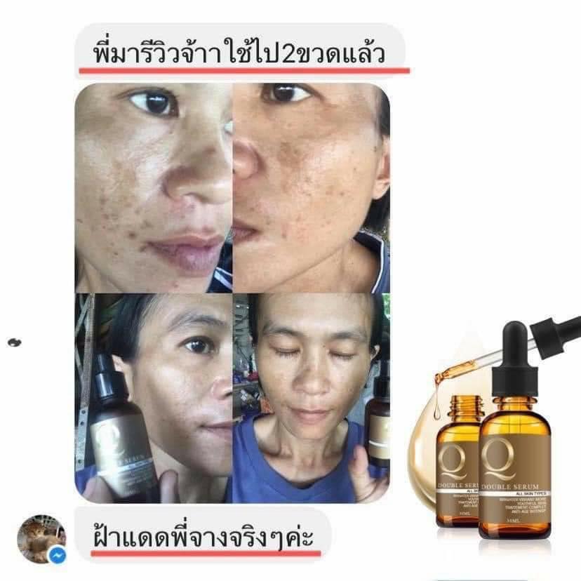 เซรั่มคิว ลดสิว ฝ้า กระ หน้าเด้ง 30ml. Q Double Serum