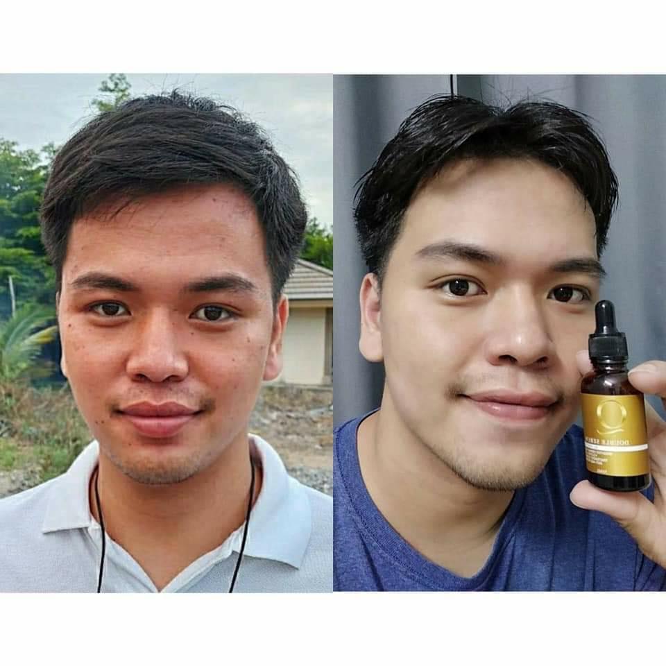 เซรั่มคิว ลดสิว ฝ้า กระ หน้าเด้ง 30ml. Q Double Serum