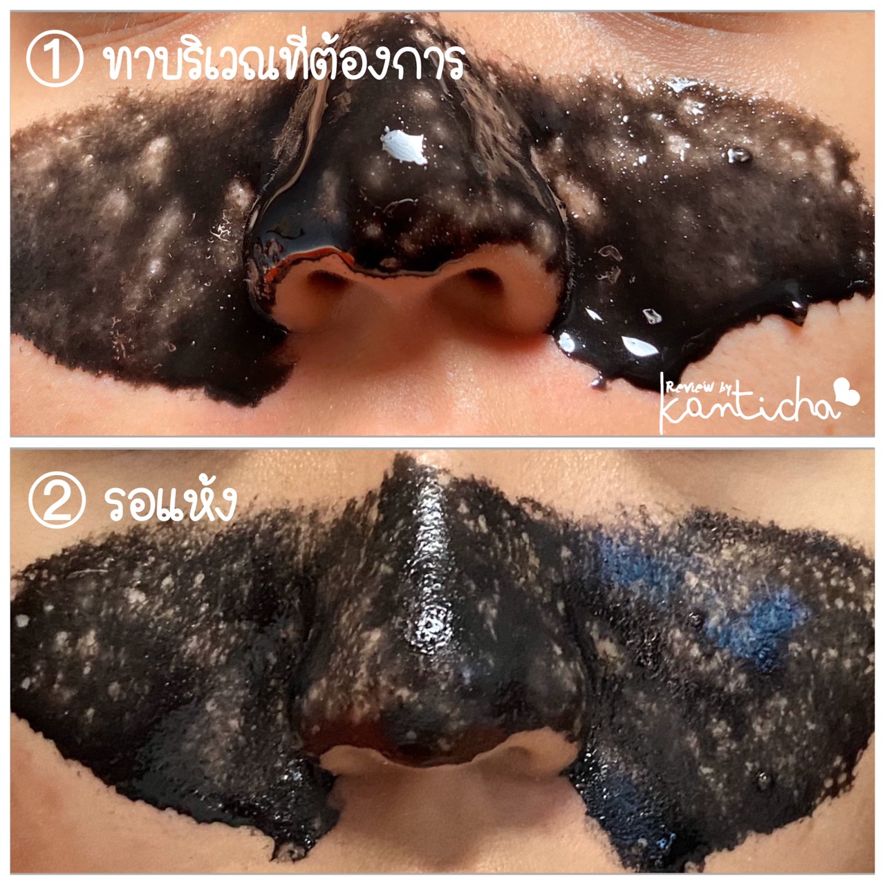 ลอกสิวเสี้ยน เอบอนเน่ มาส์กเจล ลอกสิวเสี้ยน สูตรดีท็อกซ์ 15มล. A Bonne Acne Away Detox Mask Gel.