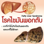 โรคไขมันพอกตับ..ตัวเร่งโรคร้าย!