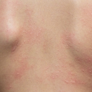 อาการผื่นคัน (ประดง) skin itching rashes eruptions